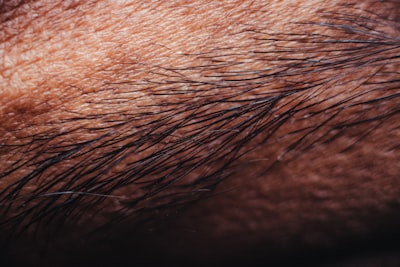 Detección de melanoma a través de análisis de lesiones en la piel