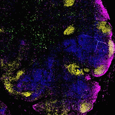 Predicción de la epilepsia postraumática con registros clínicos y modelos de lenguaje