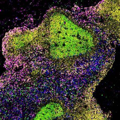 Identificación de biomarcadores de enfermedades en etapa temprana con aprendizaje profundo