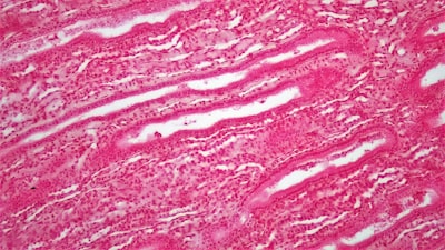 Detección temprana de múltiples cánceres con biopsia líquida y machine learning