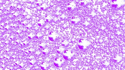 Predicción de supervivencia en glioblastoma IDH salvaje basada en histomorfología