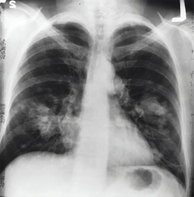Detección de neumonía a nivel de radiólogo en radiografías de tórax con DeepLearning de CheXNet