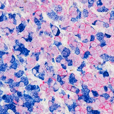  H. pylori en la letra chica: detección multiagente en biopsias