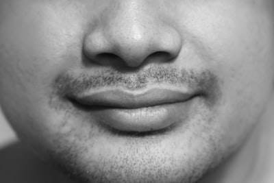 Bigote de melasma: Comprender y tratar la decoloración oscura del labio superior